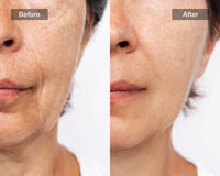 LED Light Therapy Face Mask with Neck Attachment